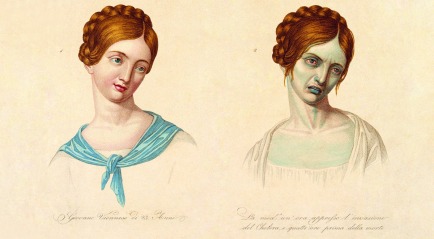 V0010485 A young Viennese woman, aged 23, depicted before and after